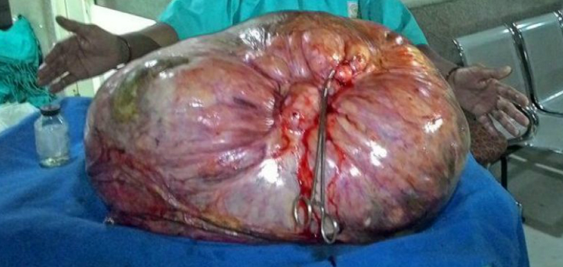 Doctors remove nearly 100 kg tumour from woman’s stomach in UP