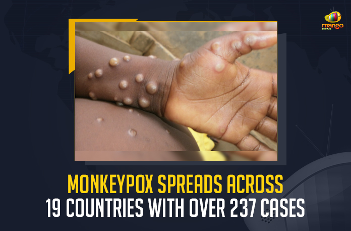 Monkeypox Spreads Across 19 Countries With Over 237 Cases