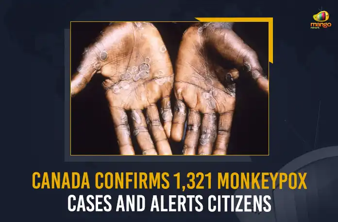 Canada Confirms 1,321 Monkeypox Cases And Alerts Citizens